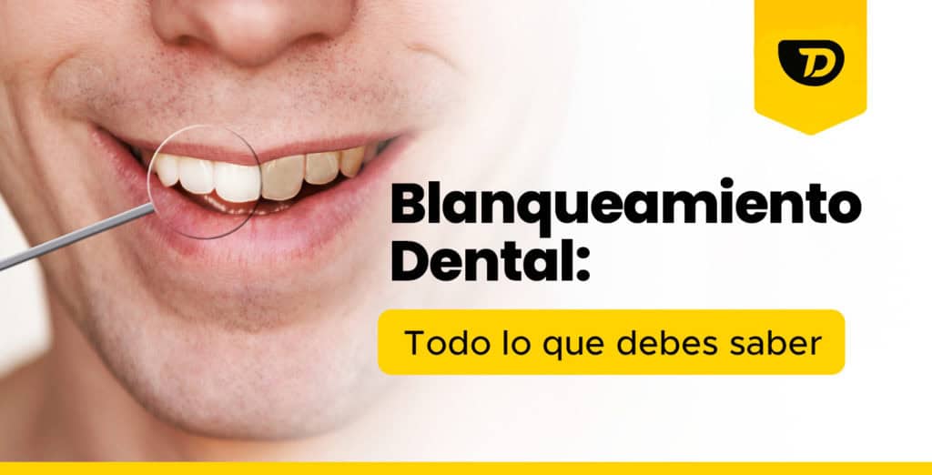 Blanqueamiento Dental: Todo lo que debes saber
