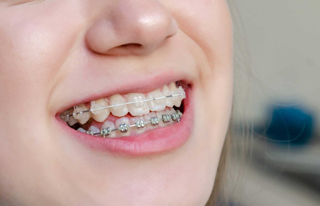 Brackets para Ortodoncia: Todo lo que necesitas saber