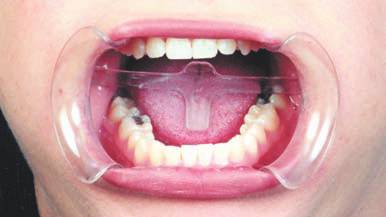 Abreboca con Retractor Lingual Cotisen (2 Unid) - Imagen 2