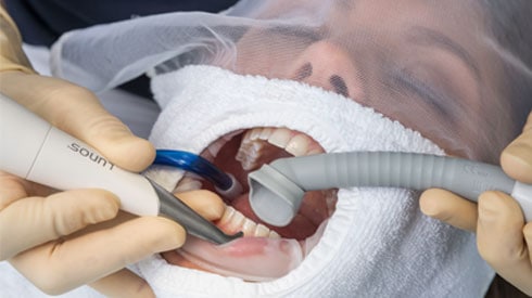Cánulas Aspiración p/profilaxis x 4 unidades, Durr Dental - Imagen 3