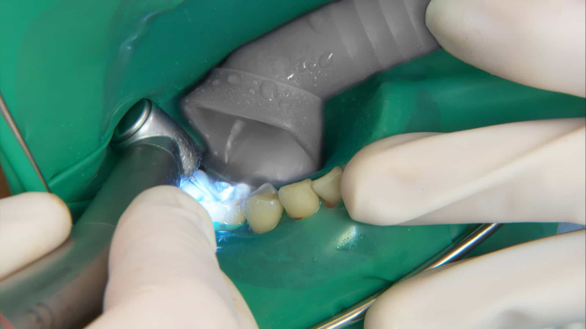 Cánulas Aspiración p/profilaxis x 4 unidades, Durr Dental - Imagen 4